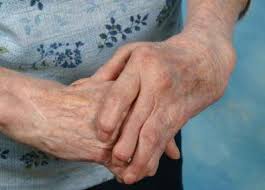 manos artritis